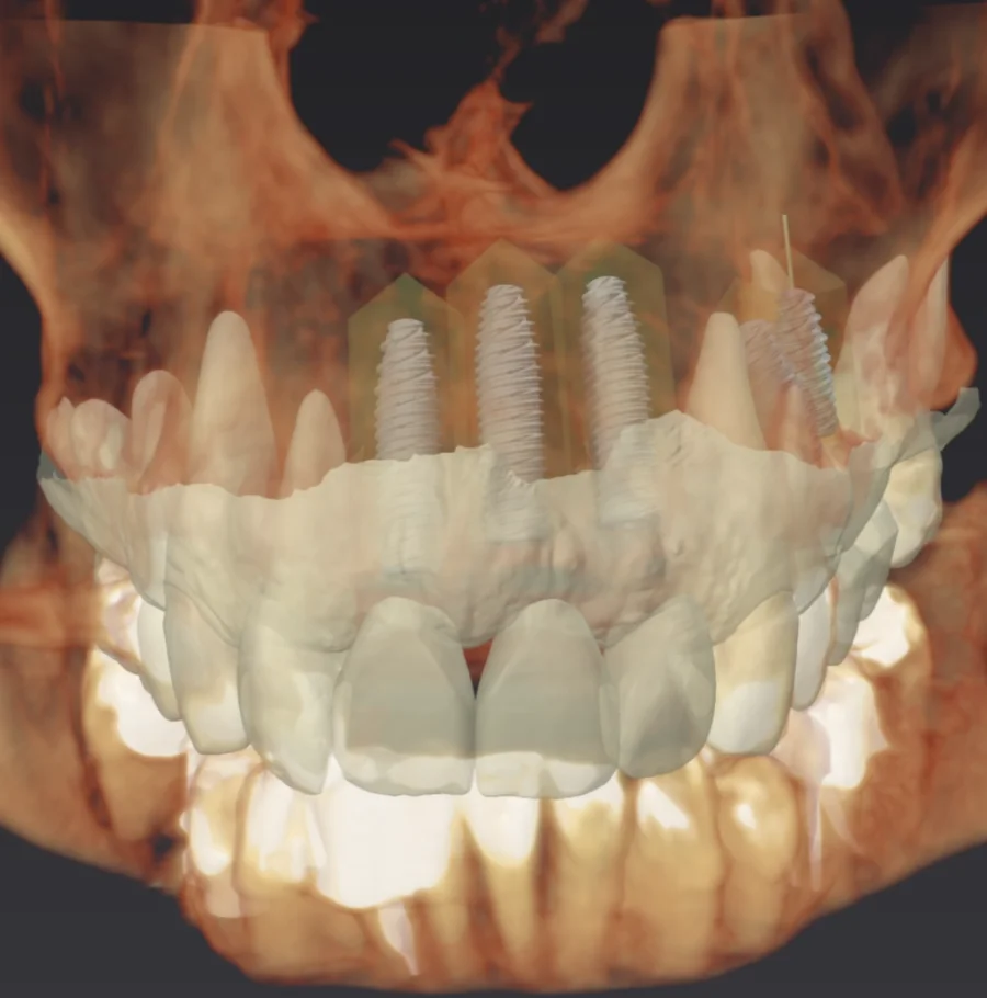 Chirurgie guidée implantologie - Dr Bouganim Paris 6
